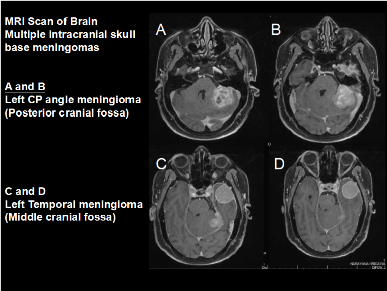 Skull base tumours - Dr Goutham Cugati