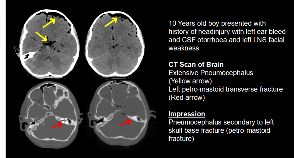 Head injuries - Dr Goutham Cugati