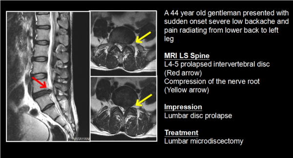 Lumbar Spondylosis - Dr Goutham Cugati