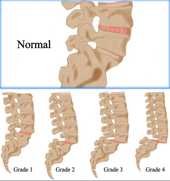 Lumbar Spondylolisthesis - Dr Goutham Cugati